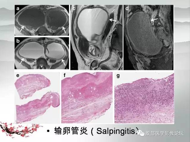 【病例】输卵管脓肿1例MR影像表现