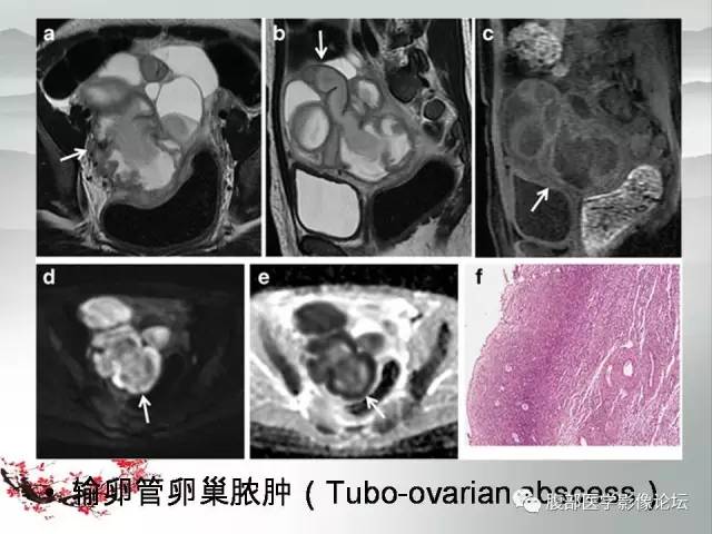 【病例】输卵管脓肿1例MR影像表现