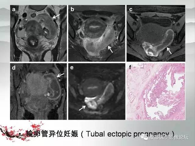 【病例】输卵管脓肿1例MR影像表现