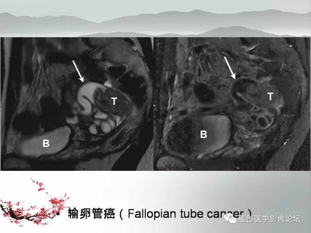 【病例】输卵管脓肿1例MR影像表现