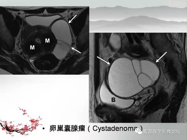 【病例】输卵管脓肿1例MR影像表现