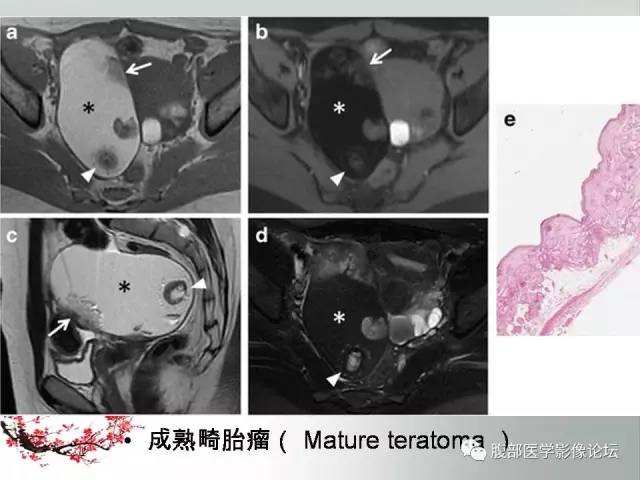 【病例】输卵管脓肿1例MR影像表现
