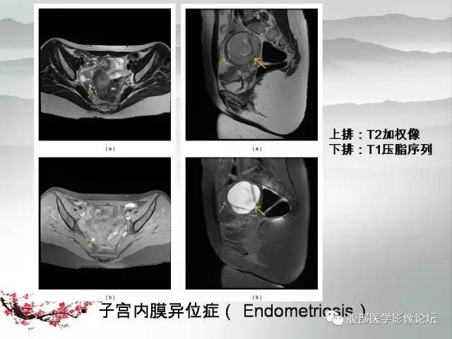 【病例】输卵管脓肿1例MR影像表现