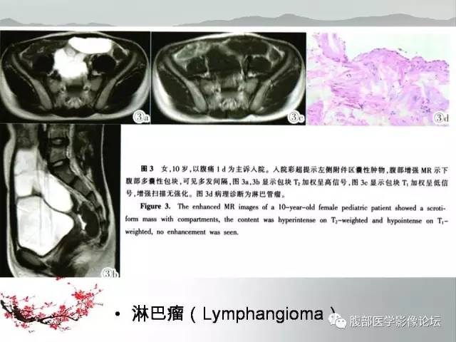 【病例】输卵管脓肿1例MR影像表现