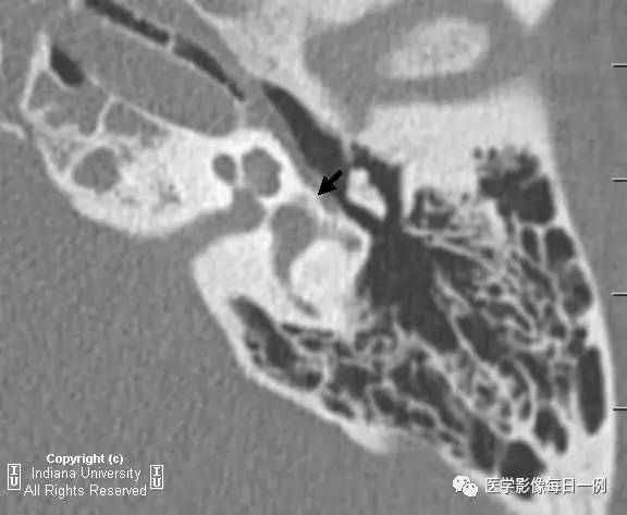 【病例】镫骨前庭窗型耳硬化症1例CT影像表现