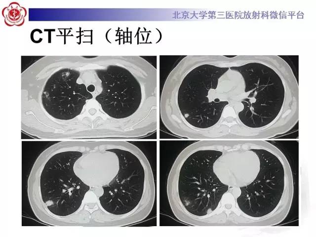 【病例】肺隐球菌病1例CT影像表现