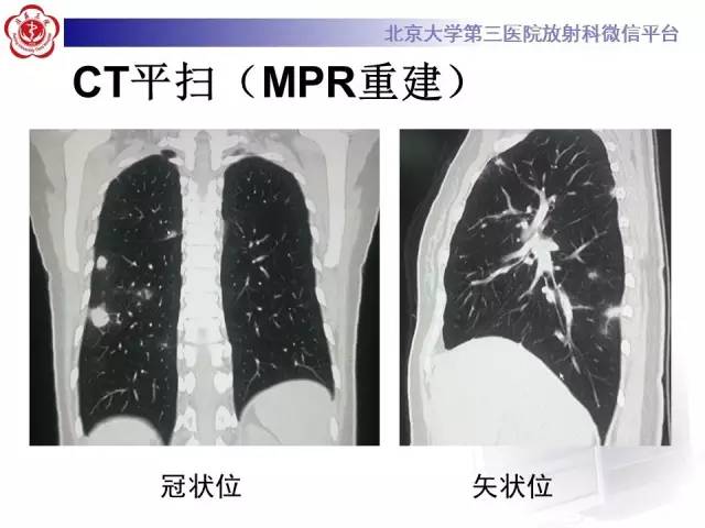 【病例】肺隐球菌病1例CT影像表现