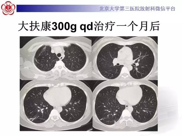 【病例】肺隐球菌病1例CT影像表现