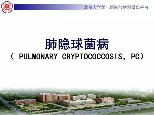 【病例】肺隐球菌病1例CT影像表现