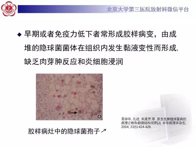 【病例】肺隐球菌病1例CT影像表现