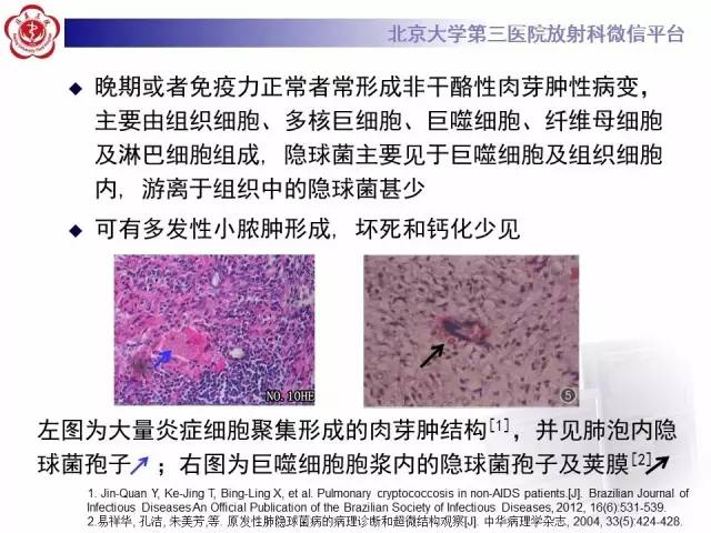 【病例】肺隐球菌病1例CT影像表现