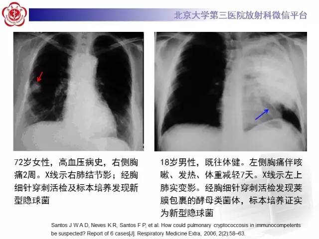 【病例】肺隐球菌病1例CT影像表现