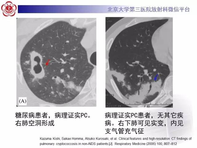 【病例】肺隐球菌病1例CT影像表现