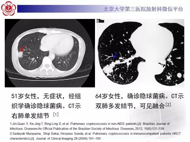 【病例】肺隐球菌病1例CT影像表现