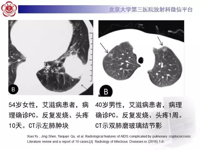 【病例】肺隐球菌病1例CT影像表现