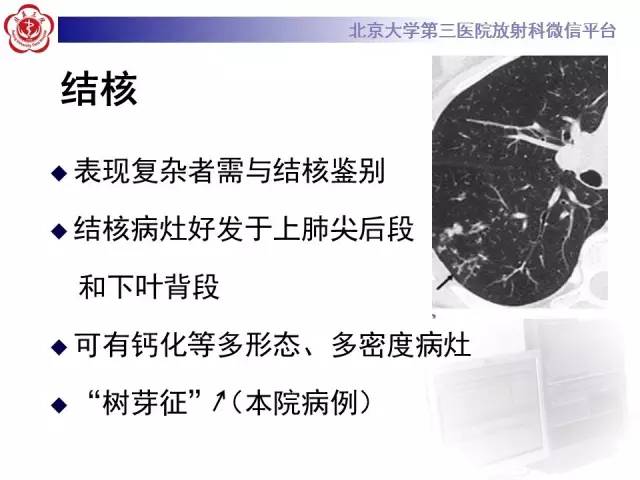 【病例】肺隐球菌病1例CT影像表现