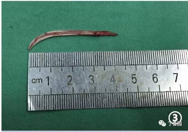 【病例】十二指肠球壁外异物残留1例CT影像表现 【病例】十二指肠球壁外异物残留1例CT影像表现