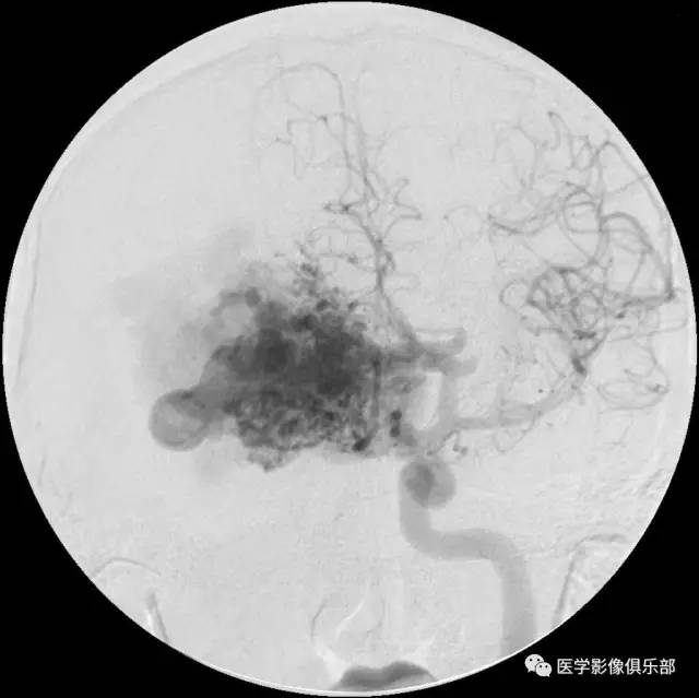 动静脉畸形(arterio-venous malformation,AVM) 动静脉畸形(arterio-venous malformation,AVM)
