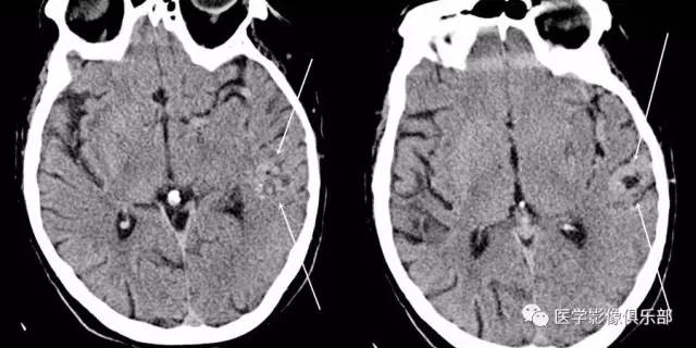 动静脉畸形(arterio-venous malformation,AVM) 动静脉畸形(arterio-venous malformation,AVM)