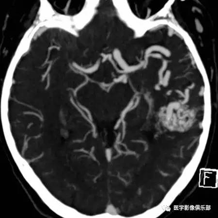 动静脉畸形(arterio-venous malformation,AVM) 动静脉畸形(arterio-venous malformation,AVM)