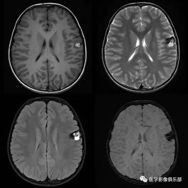 动静脉畸形(arterio-venous malformation,AVM) 动静脉畸形(arterio-venous malformation,AVM)