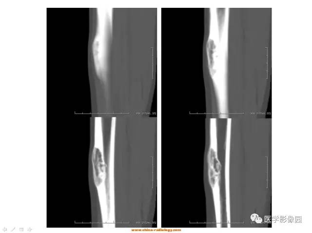 【病例】胫骨骨化性纤维瘤1例CT影像表现 【病例】胫骨骨化性纤维瘤1例CT影像表现