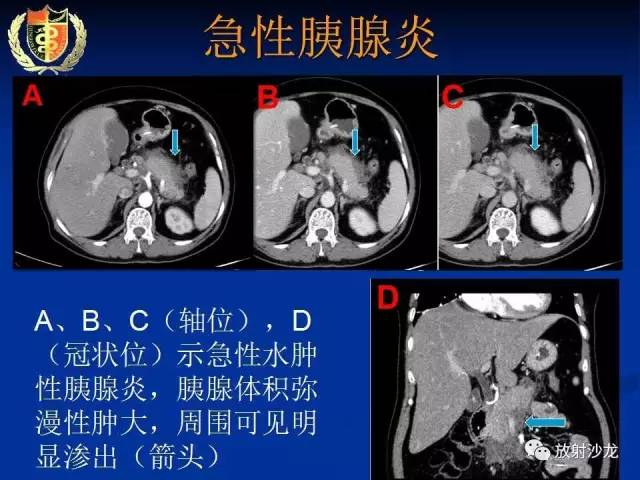 【PPT】胰腺疾病的影像诊断