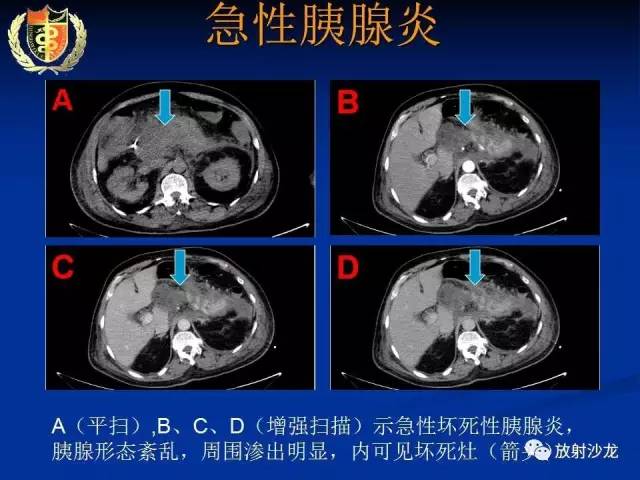 【PPT】胰腺疾病的影像诊断