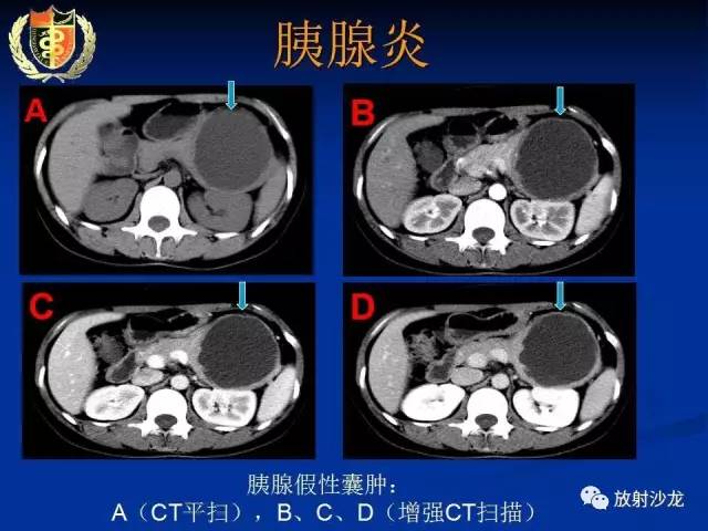 【PPT】胰腺疾病的影像诊断