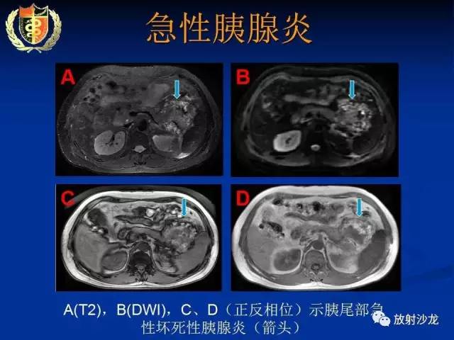 【PPT】胰腺疾病的影像诊断