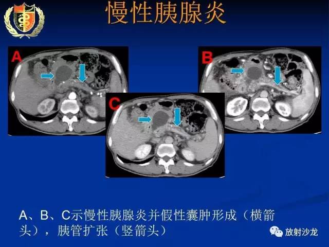 【PPT】胰腺疾病的影像诊断