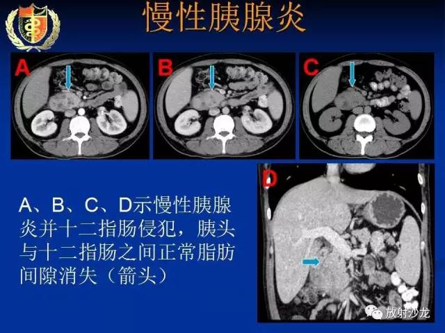 【PPT】胰腺疾病的影像诊断