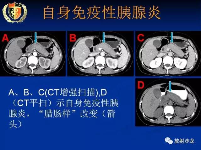 【PPT】胰腺疾病的影像诊断