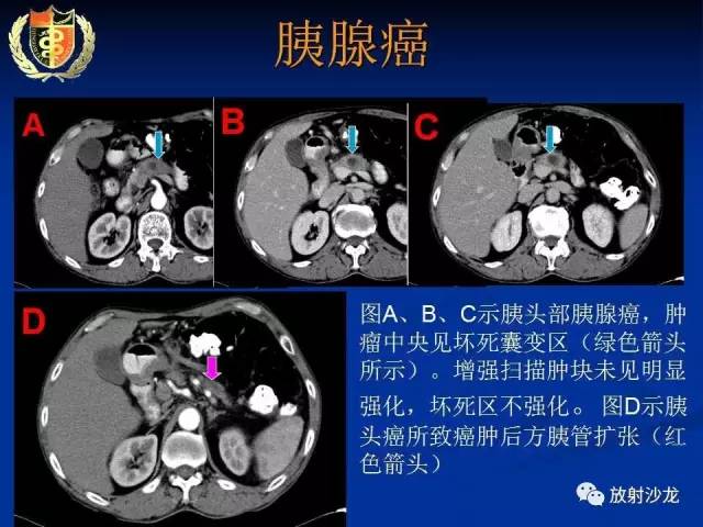 【PPT】胰腺疾病的影像诊断