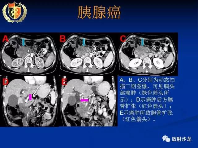 【PPT】胰腺疾病的影像诊断