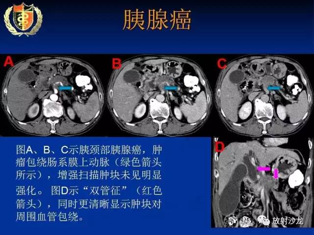 【PPT】胰腺疾病的影像诊断