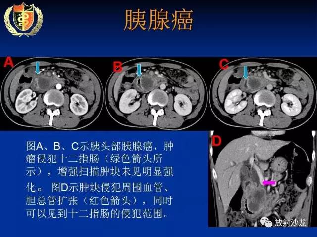 【PPT】胰腺疾病的影像诊断