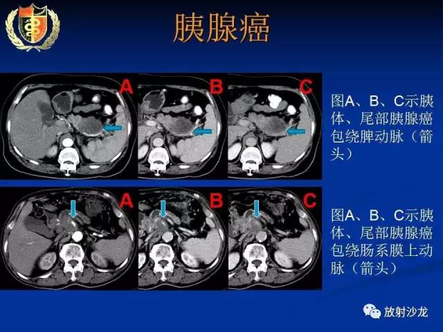 【PPT】胰腺疾病的影像诊断