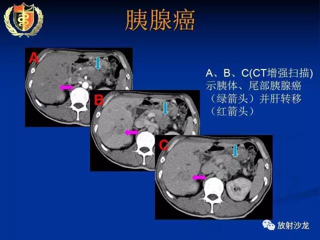 【PPT】胰腺疾病的影像诊断