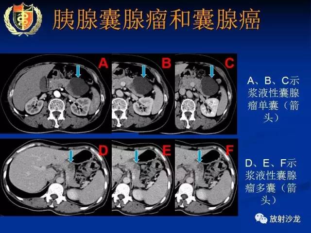 【PPT】胰腺疾病的影像诊断
