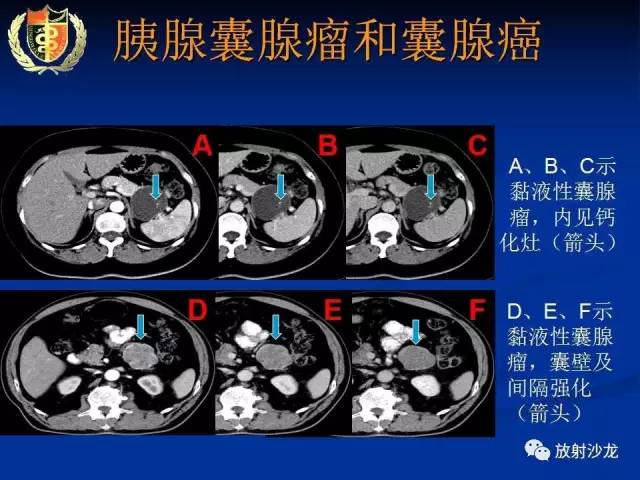【PPT】胰腺疾病的影像诊断
