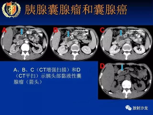 【PPT】胰腺疾病的影像诊断