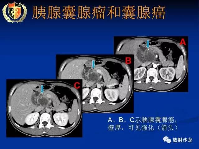 【PPT】胰腺疾病的影像诊断