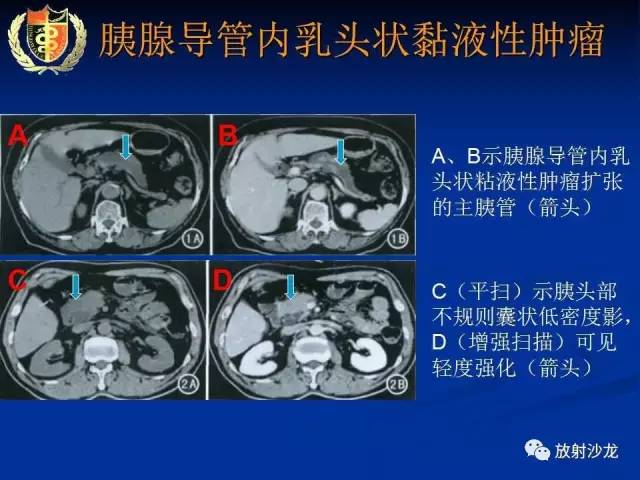 【PPT】胰腺疾病的影像诊断