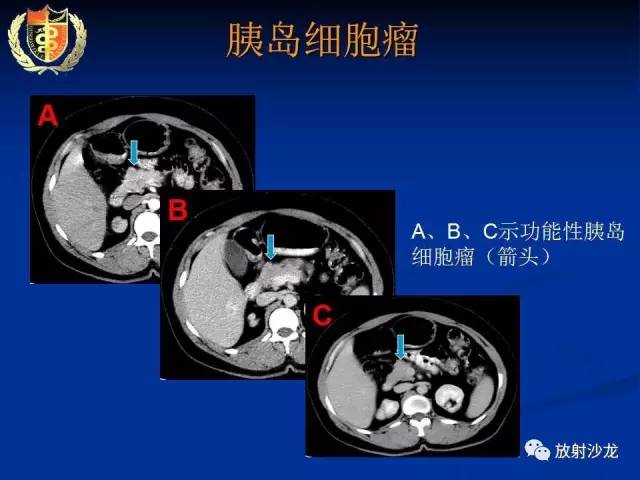 【PPT】胰腺疾病的影像诊断
