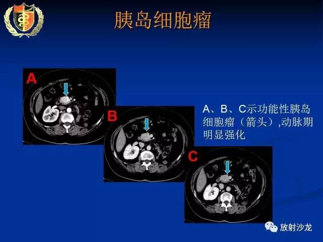 【PPT】胰腺疾病的影像诊断