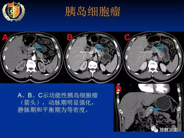 【PPT】胰腺疾病的影像诊断