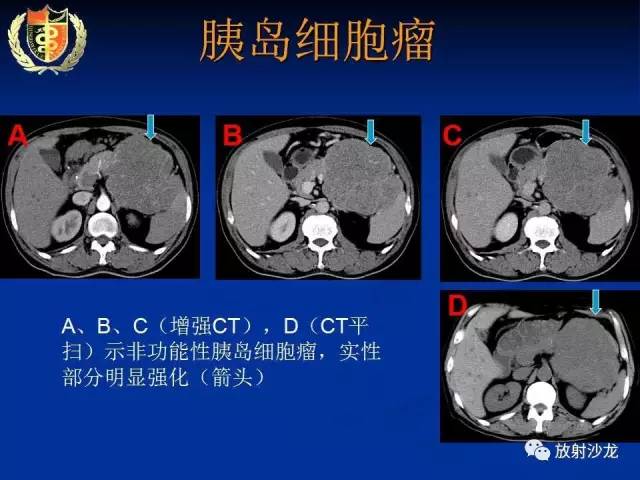 【PPT】胰腺疾病的影像诊断