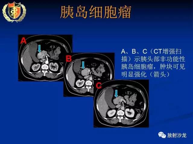 【PPT】胰腺疾病的影像诊断