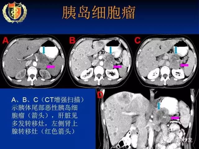 【PPT】胰腺疾病的影像诊断